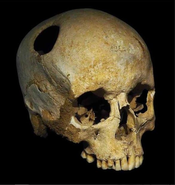 کشف طلسم‌های 5500 ساله از جمجمه انسان
