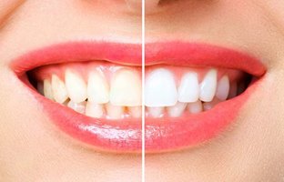 چطوری از شر زردی دندان هایمان خلاص شویم؟ از روش‌های درمانی تا راه‌حل‌های خانگی