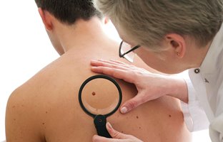 سرطان پوست چیست و آیا کشنده است؟ عوامل، پیشگیری و درمان
