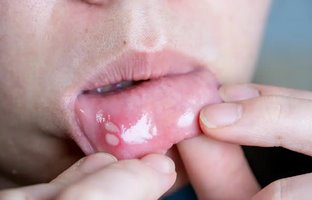 آفت دهان چیست؟ علائم و روش‌های پیشگیری و درمان