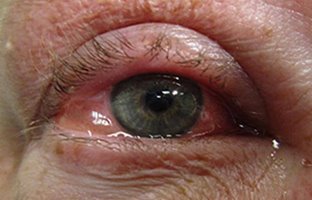 التهاب چشم ناشی از حساسیت؛ علل، نشانه ها و راه های درمان آن